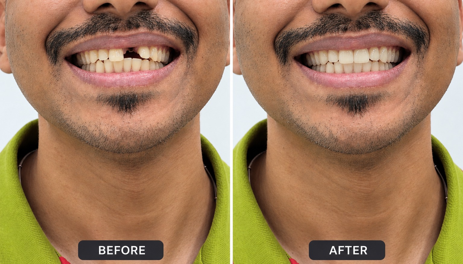 Before and after dental implant treatment